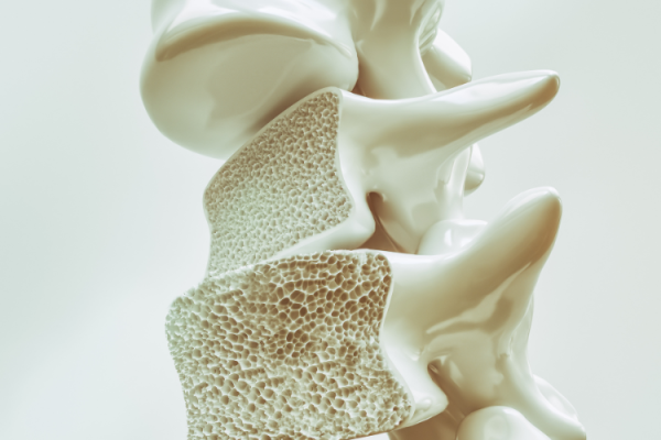 penyebab osteoporosis atau tulang keropos