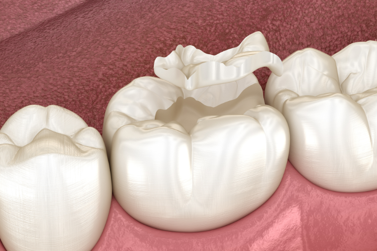 tambal gigi jember di rolas dental care 
